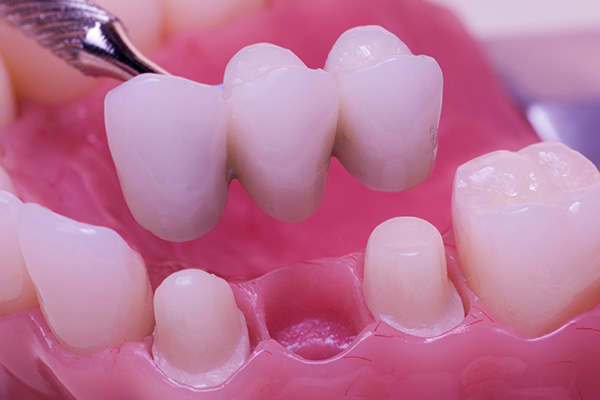 How To Care For A Fixed Dental Bridge