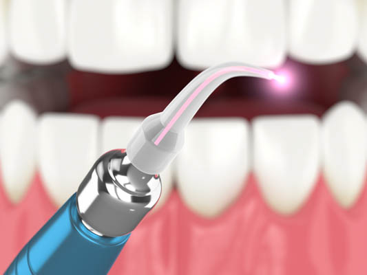 How Laser Dentistry Is Used To Reshape Gums